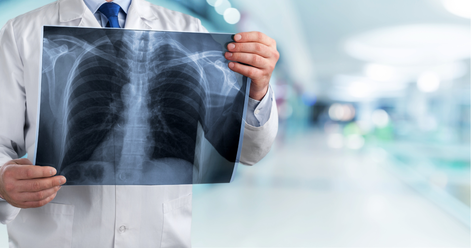 Doctor holding a chest X-ray image for COPD diagnosis